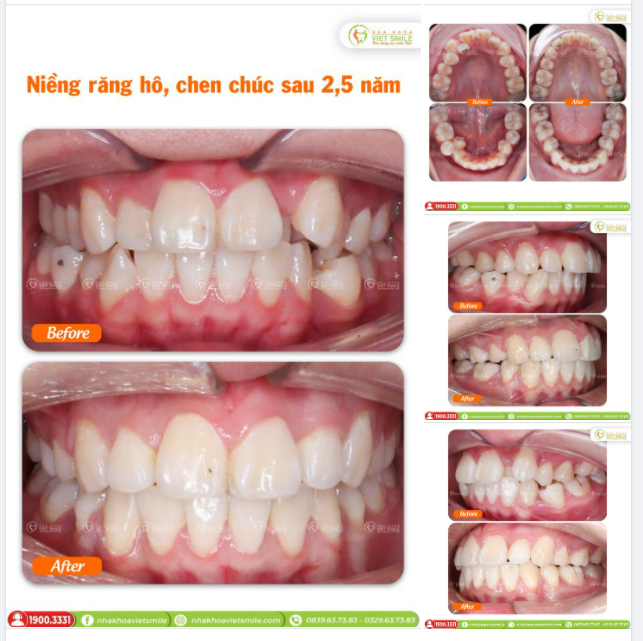 THÁO NIỀNG RĂNG KHỚP CẮN HỞ SAU 19 THÁNG