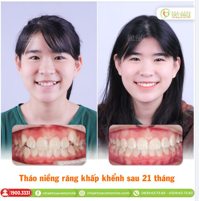 THÁO NIỀNG RĂNG KHẤP KHỂNH SAU 21 THÁNG