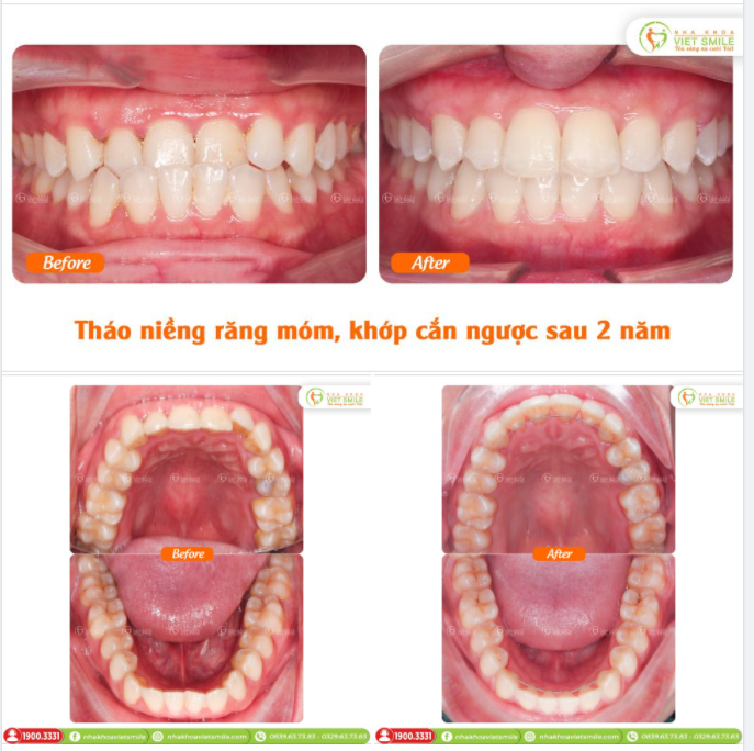 THÁO NIỀNG RĂNG MÓM, KHỚP CẮN NGƯỢC SAU 2 NĂM