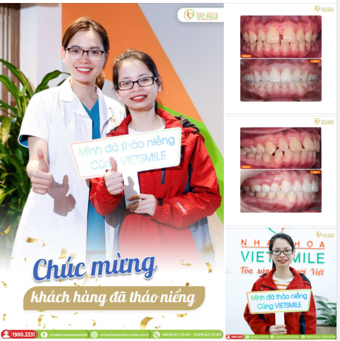THÁO NIỀNG RĂNG THƯA, HÔ SAU HƠN 2 NĂM