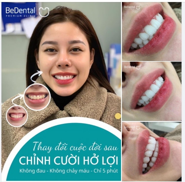 Thay đổi cuộc đời sau chỉnh cười hở lợi kết hợp dán sứ Veneer