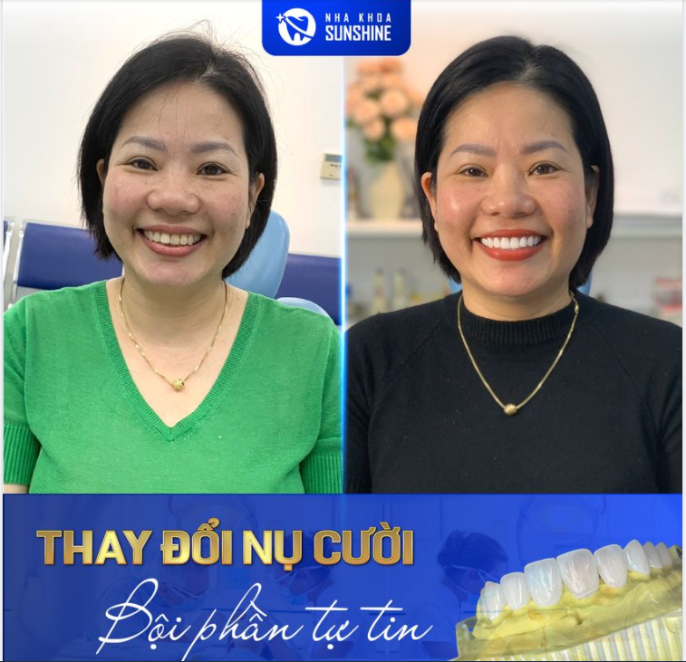 THAY ĐỔI NỤ CƯỜI, BỘI PHẦN TỰ TIN