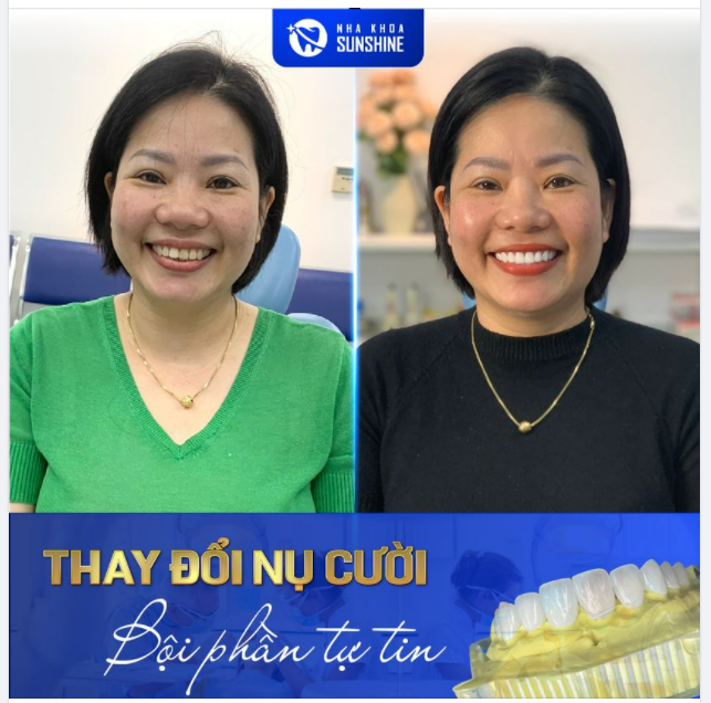 THAY ĐỔI NỤ CƯỜI, BỘI PHẦN TỰ TIN
