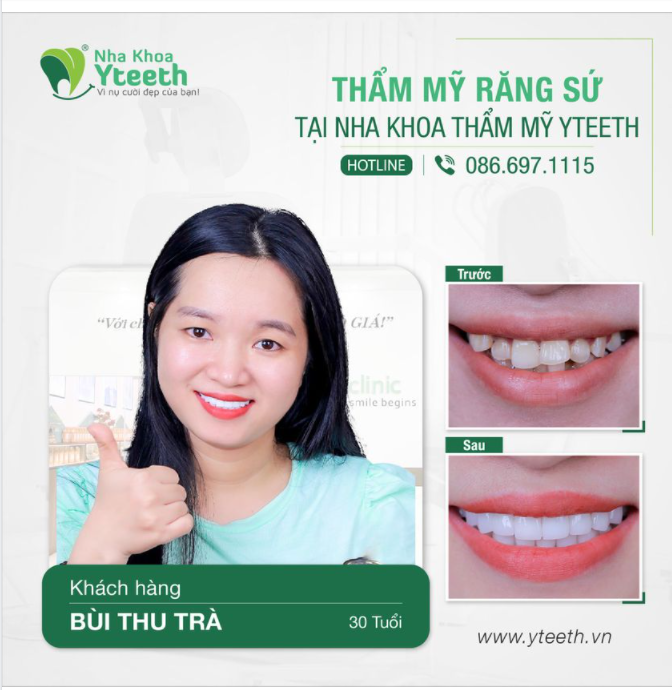 Thay đổi nụ cười cho chị khách hàng 30 tuổi 