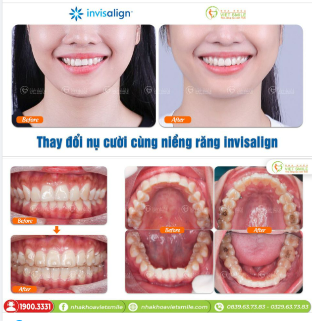 THAY ĐỔI NỤ CƯỜI CÙNG NIỀNG RĂNG TRONG SUỐT INVISALIGN
