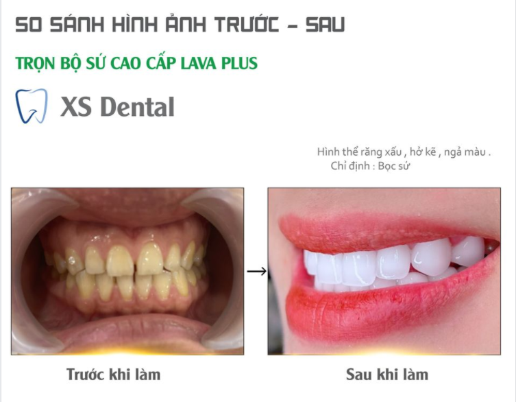 Thay đổi nụ cười hở kẽ tức thì với trọn bộ răng sứ thẩm mỹ Lava Plus tại nha khoa  XS Dental