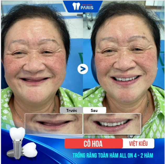 Thay đổi nụ cười - trẻ ra 10 tuổi với phương pháp phục hình răng all on toàn hàm