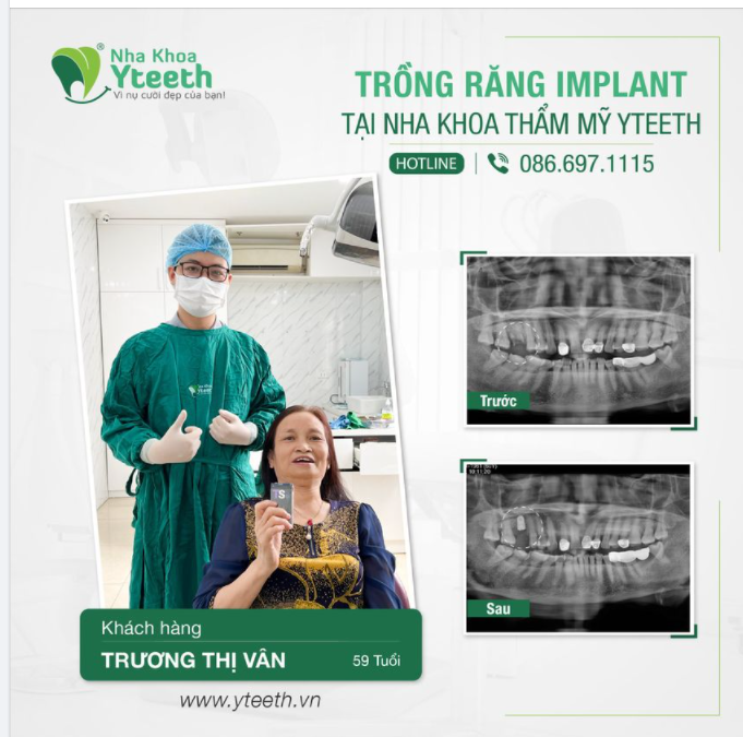 THAY THẾ RĂNG MẤT - BỀN CHẮC LÂU DÀI