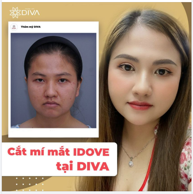 Thì ra…cắt mí mắt đẹp…là ở DIVA
