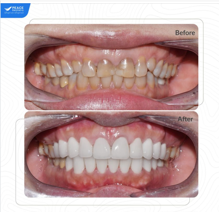 Thiết kế lại nụ cười với răng sứ thẩm mỹ kết hợp phẫu thuật cắt nướu làm dài thân răng