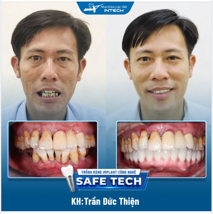 THOẢI MÁI ĂN NHAI, TỰ TIN GIAO TIẾP VỚI CÔNG NGHỆ TRỒNG RĂNG IMPLANT SAFE-TECH