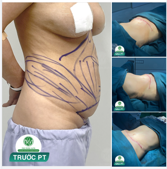 THOÁT BÉO THẬT DỄ DÀNG VỚI COMBO HÚT MỠ + CĂNG DA BỤNG