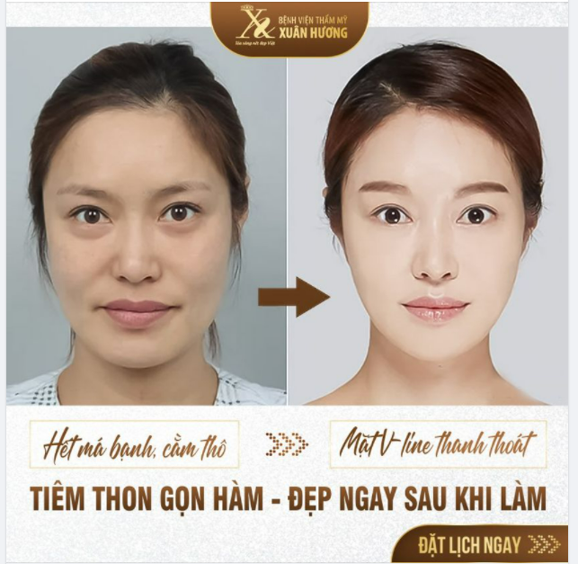 THON GỌN HÀM KHÔNG PHẪU THUẬT - LỰA CHỌN HÀNG ĐẦU DÀNH CHO TEAM MÁ BẠNH, CẰM VUÔNG!
