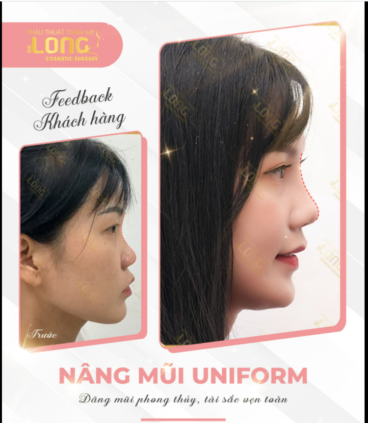 THU HÚT MỌI ÁNH NHÌN VỚI DÁNG MŨI CAO XINH