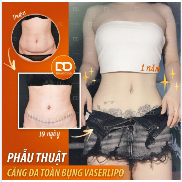 Thực hiện hút mỡ tại Thẩm mỹ DrD, khách hàng hoàn toàn yên tâm 