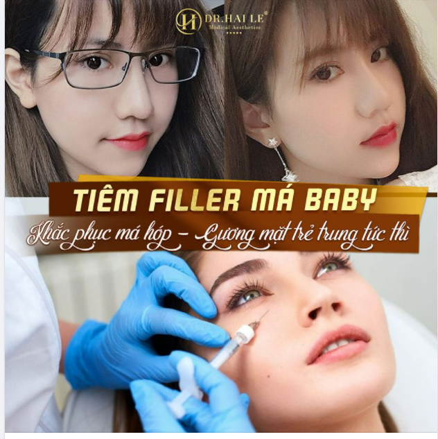 TIÊM FILLER MÁ BABY - TẠO HÌNH KHUÔN MẶT TRẺ TRUNG - THU HÚT MỌI ÁNH NHÌN