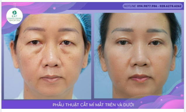 “Tìm lại thanh xuân qua đôi mắt”