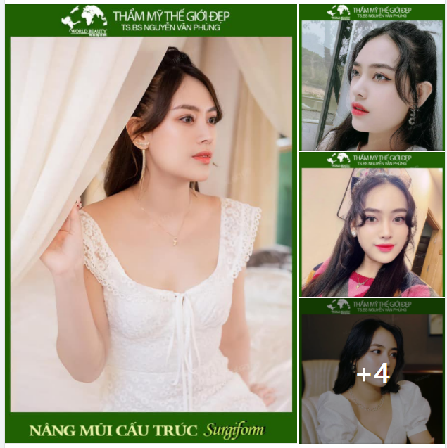 Tình trạng mũi trước phẫu thuật của quý Cô sau 2 lần nâng cấp bằng chỉ nâng và chất làm đầy nhưng không hài lòng.