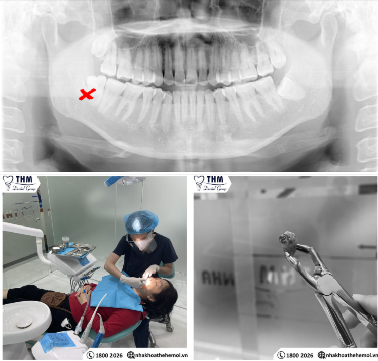 TIP dành cho những bạn chuẩn bị đi nhổ răng khôn