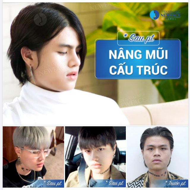 TỎA SÁNG VẺ ĐẸP UNIS.E...X NHỜ NÂNG MŨI CẤU TRÚC