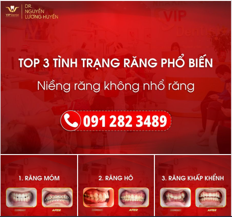 TOP 3 TÌNH TRẠNG RĂNG PHỔ BIẾN CỦA KHÁCH HÀNG KHI LỰA CHỌN NIỀNG RĂNG KHÔNG NHỔ RĂNG