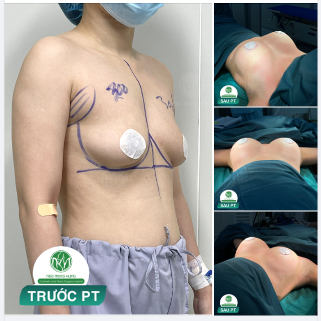 TRẢ KẾT QUẢ CA NÂNG NGỰC CHO KHÁCH HÀNG