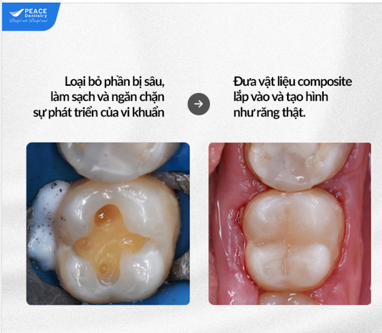 TRÁM RĂNG SÂU BẰNG PHƯƠNG PHÁP TRÁM RĂNG THẨM MỸ - VẬT LIỆU COMPOSITE