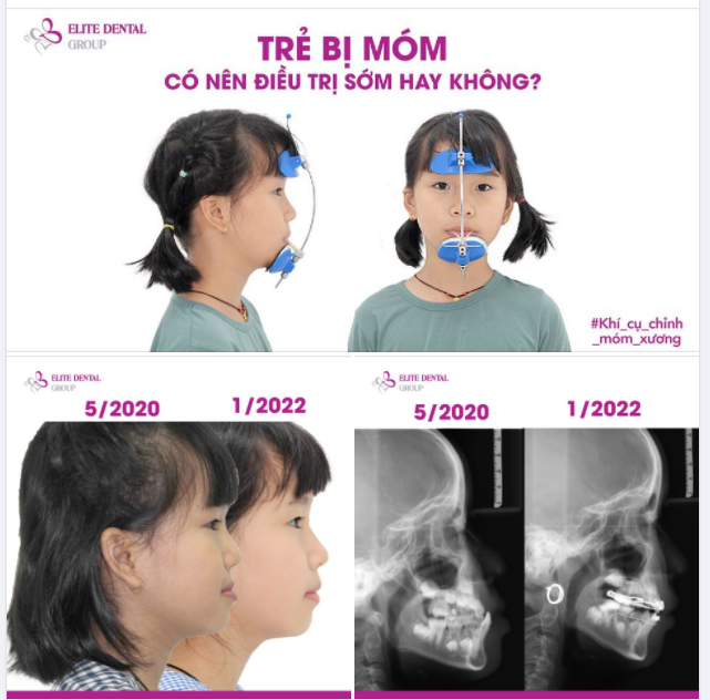 TRẺ BỊ MÓM CÓ NÊN ĐIỀU TRỊ SỚM HAY KHÔNG