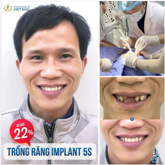 TRẺ RA CHỤC TUỔI SAU KHI TRỒNG RĂNG IMPLANT