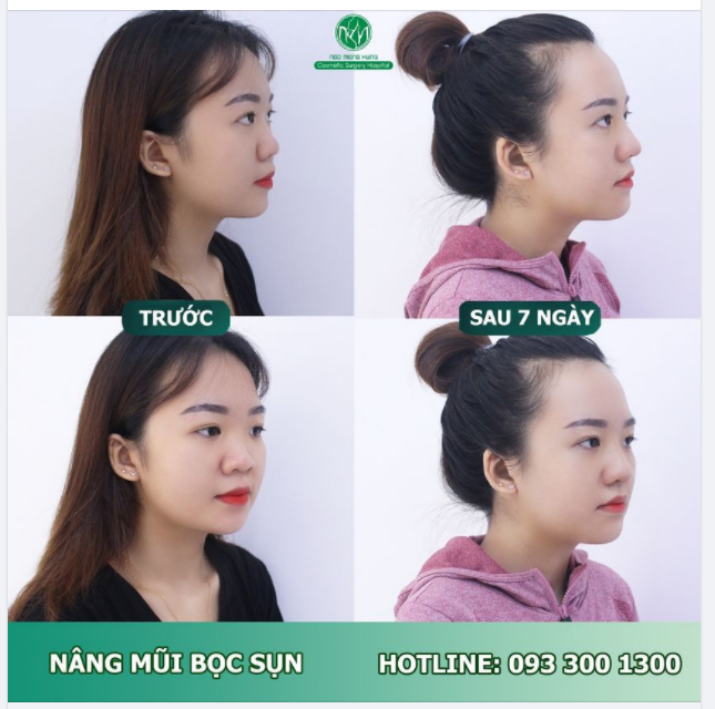 TRỞ NÊN XINH ĐẸP VÀ THẦN THÁI HƠN SAU NÂNG MŨI