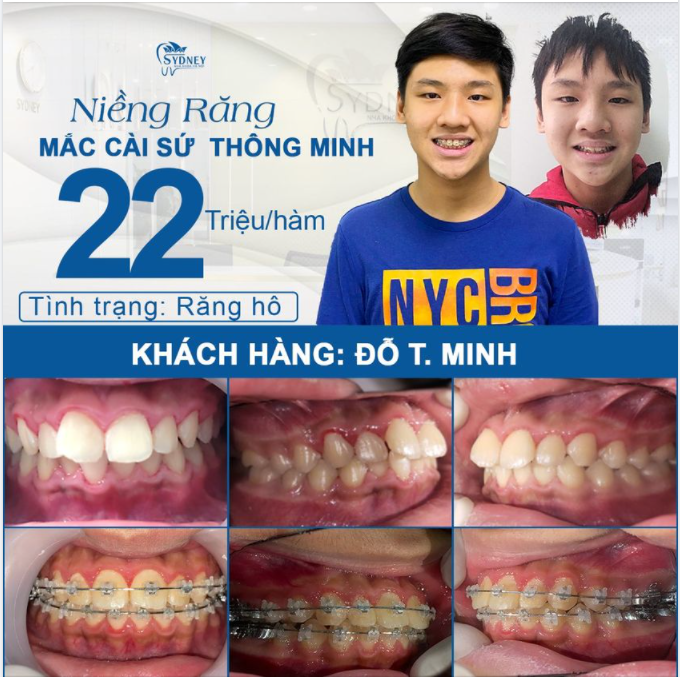 Trông bạn như thế nào sau 3,6 hay 12 tháng niềng răng 