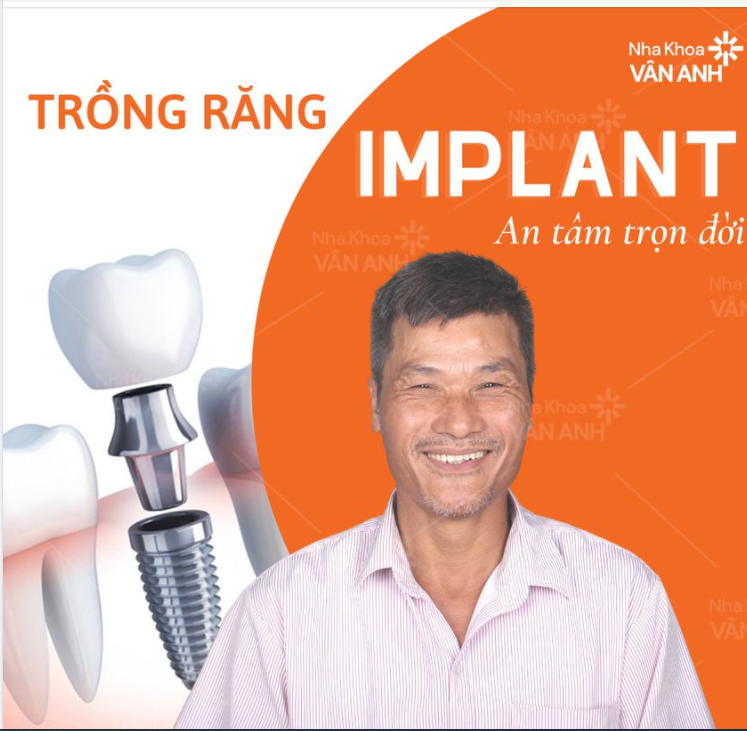 TRỒNG RĂNG IMPLANT 1 LẦN, AN TÂM TRỌN ĐỜI