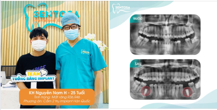 TRỒNG RĂNG IMPLANT CÓ THẬT SỰ ĐÁNG SỢ 