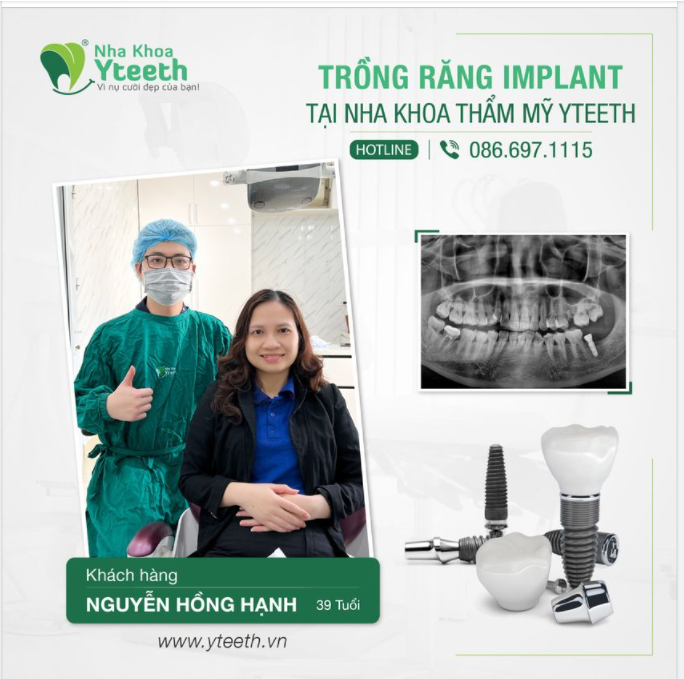 Trồng răng Implant kết hợp phục hình răng sứ cho chị khách hàng 39 tuổi.