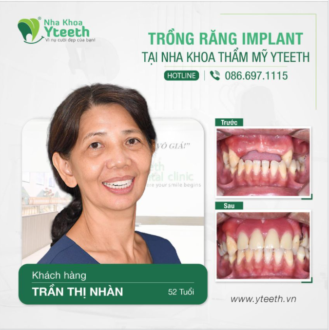 Trồng răng Implant kết hợp phục hình răng sứ cho cô khách hàng 52 tuổi.