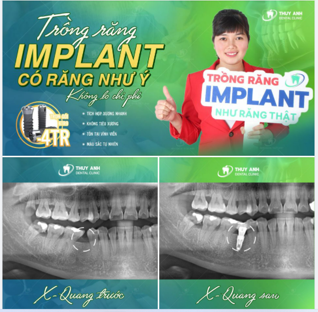 TRỒNG RĂNG IMPLANT - KHÔNG LO CHI PHÍ
