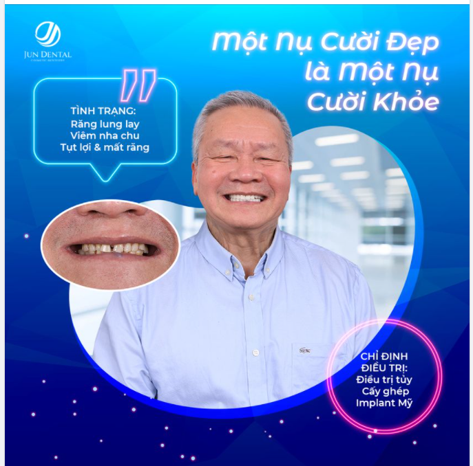 TRỒNG RĂNG IMPLANT - PHƯƠNG PHÁP SỞ HỮU NỤ CƯỜI KHÔNG CHỈ ĐẸP MÀ CÒN KHỎE