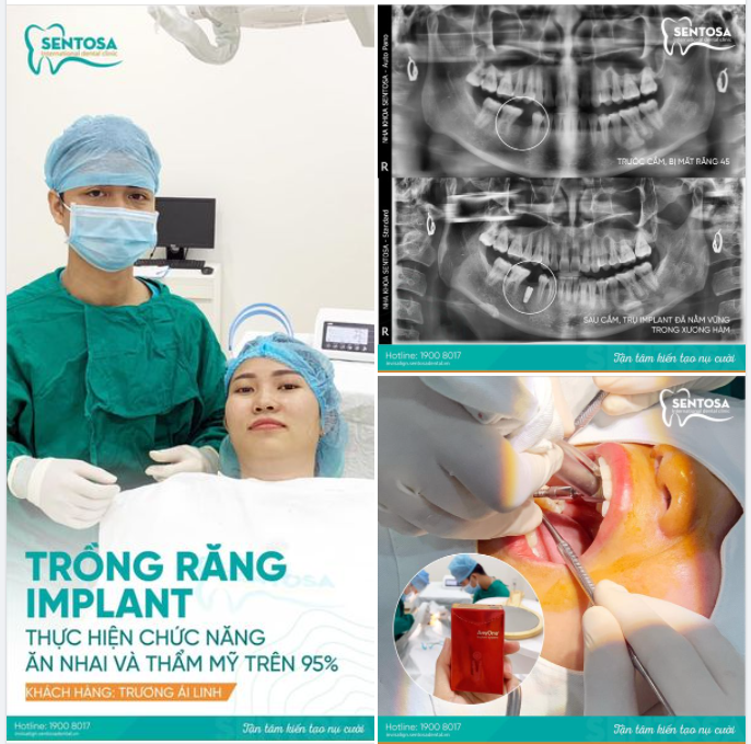 TRỒNG RĂNG IMPLANT THỰC HIỆN CHỨC NĂNG ĂN NHAI & THẨM MỸ TRÊN 95%