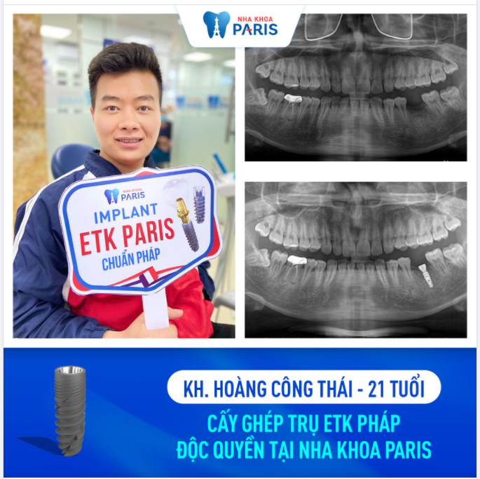 Trụ Implant ETK Pháp - Độc quyền tại Nha khoa Paris
