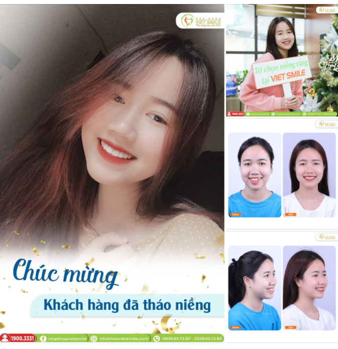 TỰ TIN CƯỜI ĐẸP HƠN SAU THÁO NIỀNG RĂNG CHEN CHÚC, KHẤP KHỂNH
