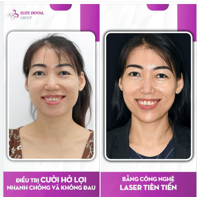 Tự tin cười thật tươi sau điều trị cười hở lợi bằng giải pháp cắt nướu tại Elite Dental