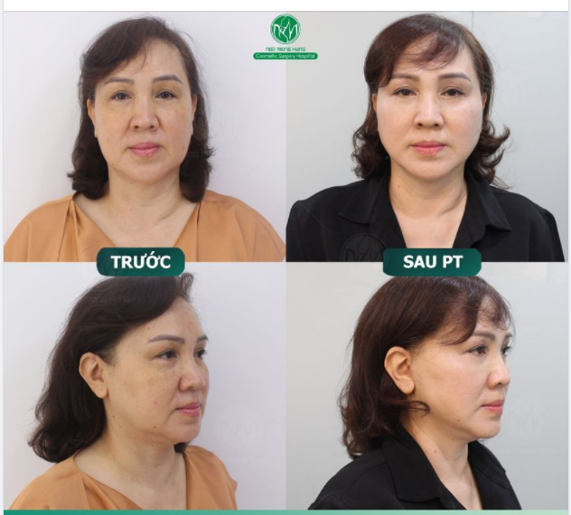 TỰ TIN ĐÁNH BẠI LÃO HÓA VỚI PHƯƠNG PHÁP CĂNG DA MẶT