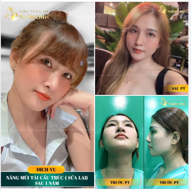 TỰ TIN KHOE CHIẾC MŨI XINH SAU HAI LẦN PHẪU THUẬT