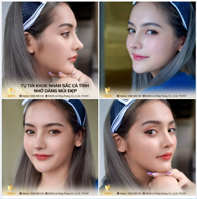 TỰ TIN KHOE NHAN SẮC CÁ TÍNH NHỜ DÁNG MŨI ĐẸP