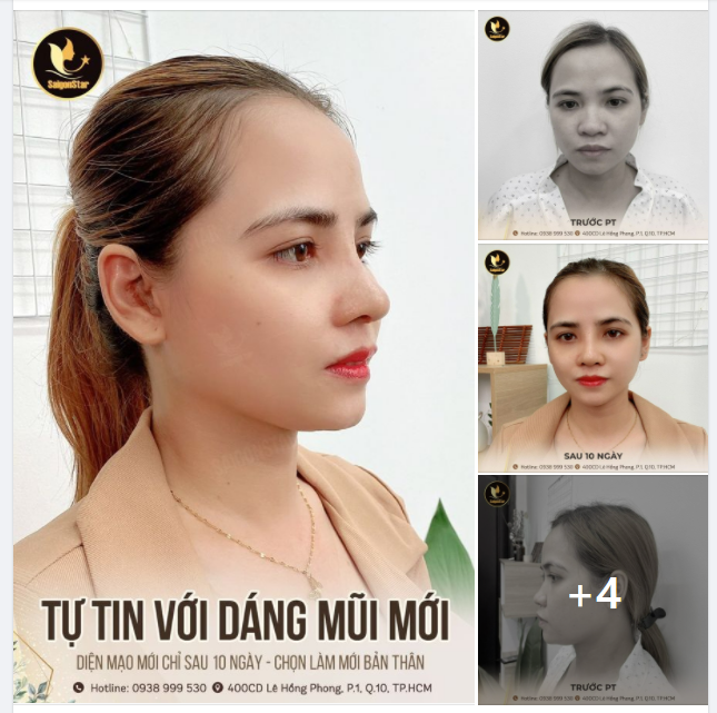TỰ TIN VỚI DÁNG MŨI MỚI - DIỆN MẠO MỚI CHỈ SAU 10 NGÀY CHỌN LÀM MỚI BẢN THÂN