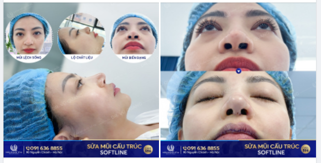 Từng không chấp nhận bản thân! Từng suy sụp khi thấy chiếc mũi biến dạng trong gương!