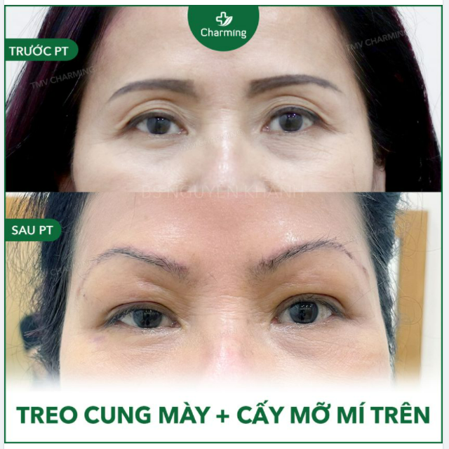 ​​​​​​​ Tưởng chừng đâu việc lấy lại nét thanh xuân cho đôi mắt của nàng là chuyện rất khó, nhưng ai dè, chuyện gì khó đã có Charming lo.