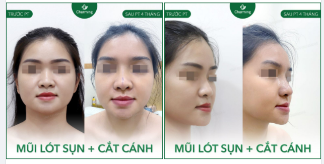 Tuy nàng khách chỉ mới nâng mũi lót sụn và cắt cánh mũi 7 ngày và chiếc mũi mới vẫn chưa hoàn toàn vào gom dáng nhưng vẫn đủ thấy được chiếc mũi mới đã được cải thiện đáng kể