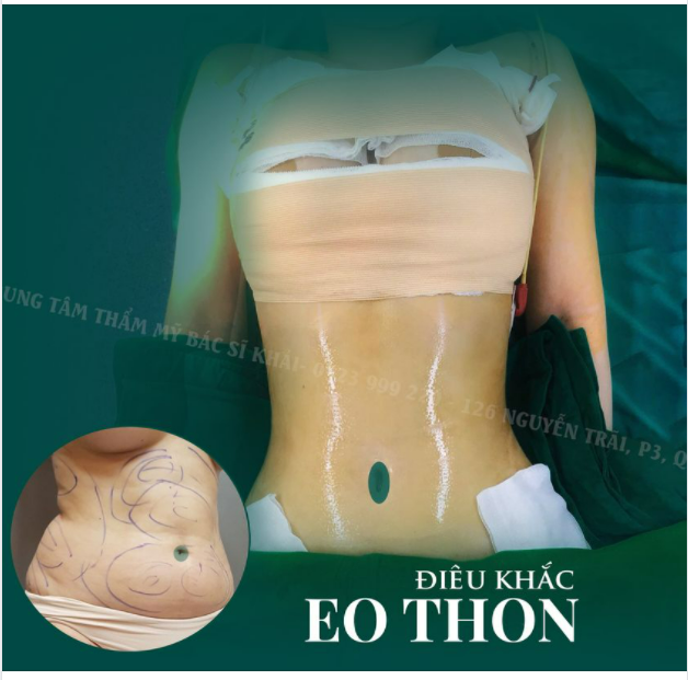 TUYỆT PHẨM CĂNG DA DỜI RỐN thường kết hợp cùng HÚT MỠ