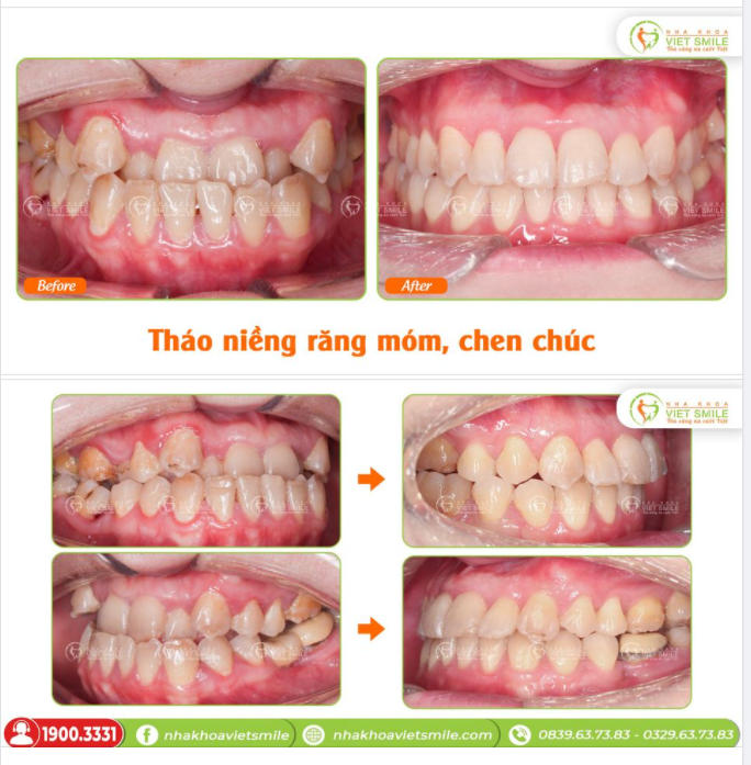U40 - THÁO NIỀNG RĂNG MÓM, CHEN CHÚC SAU 3 NĂM